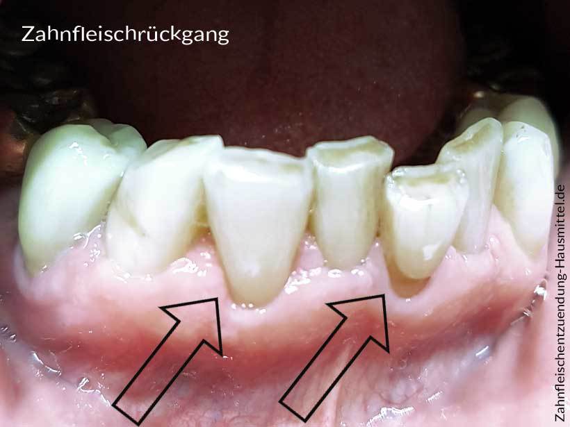 Zahnfleischrückgang Hilfe