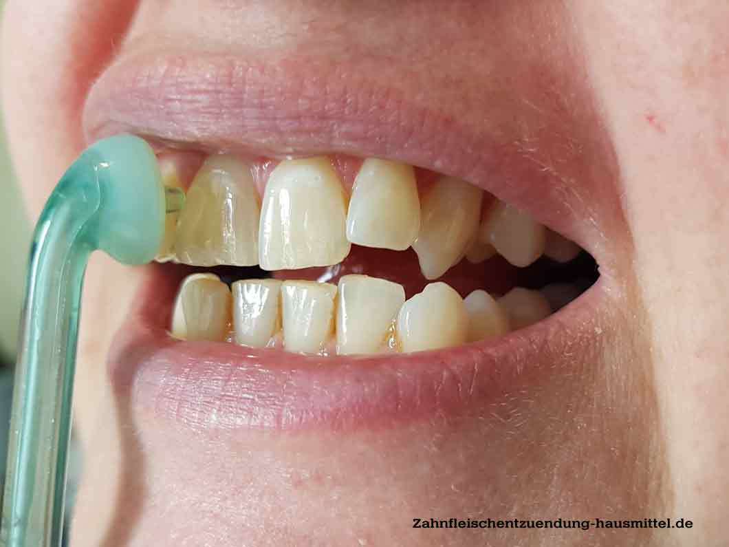 Munddusche gegen Zahnfleischrückgang