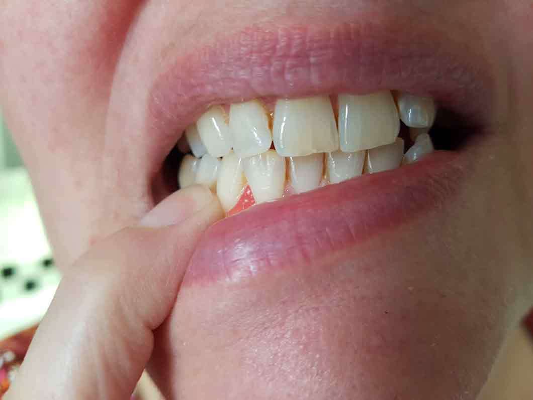Zahnfleischentzündung Behandlung beim Zahnarzt